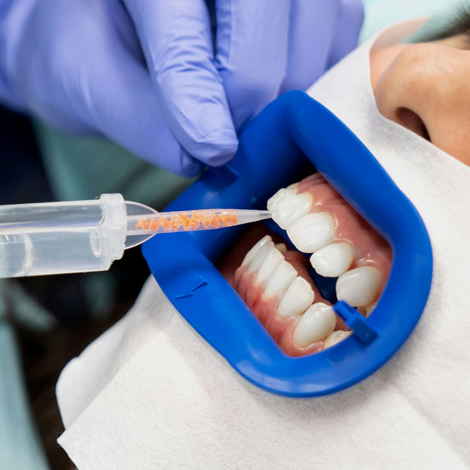 Teeth Whitening Mitchellville, MD Silver Spring, MD Bowie, MD