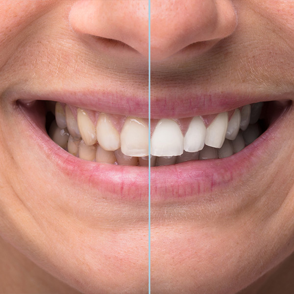 Smile before and after teeth whitening