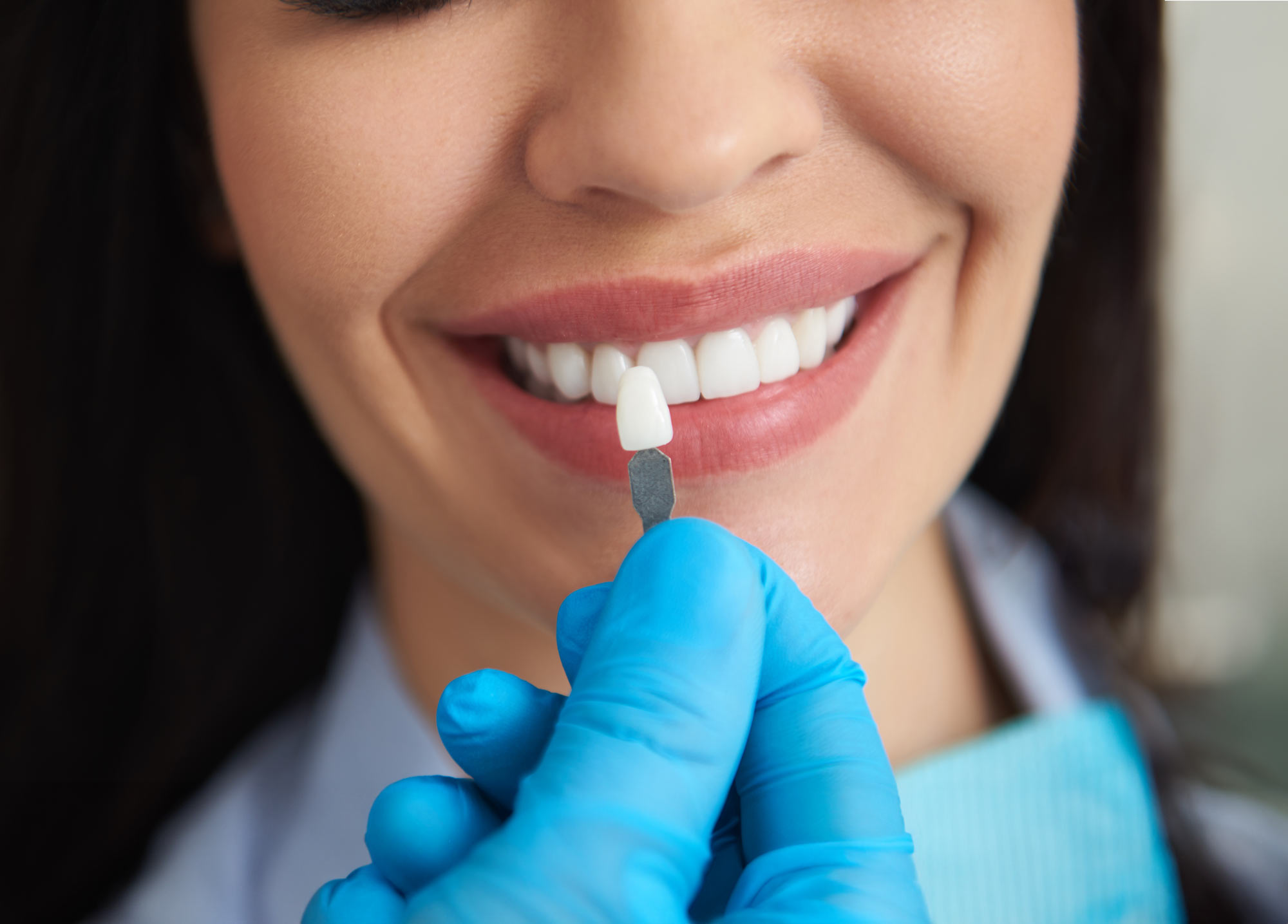 comparing teeth whitening to a shade