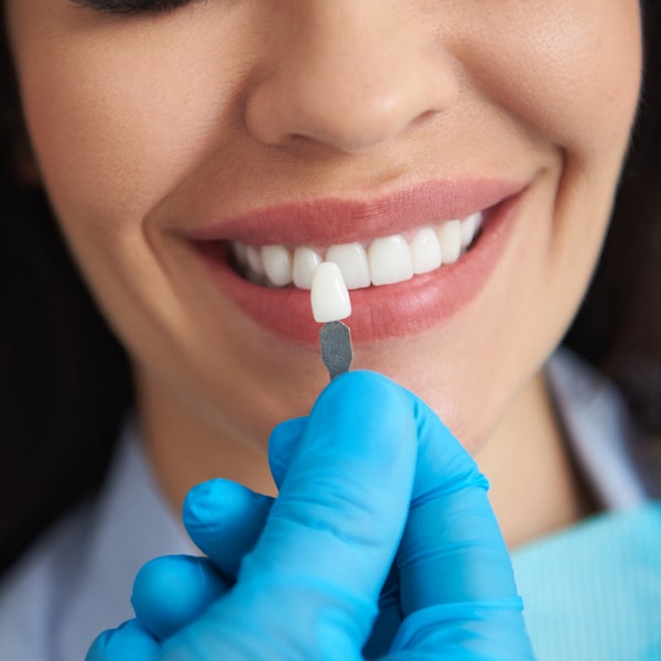 comparing teeth whitening to a shade