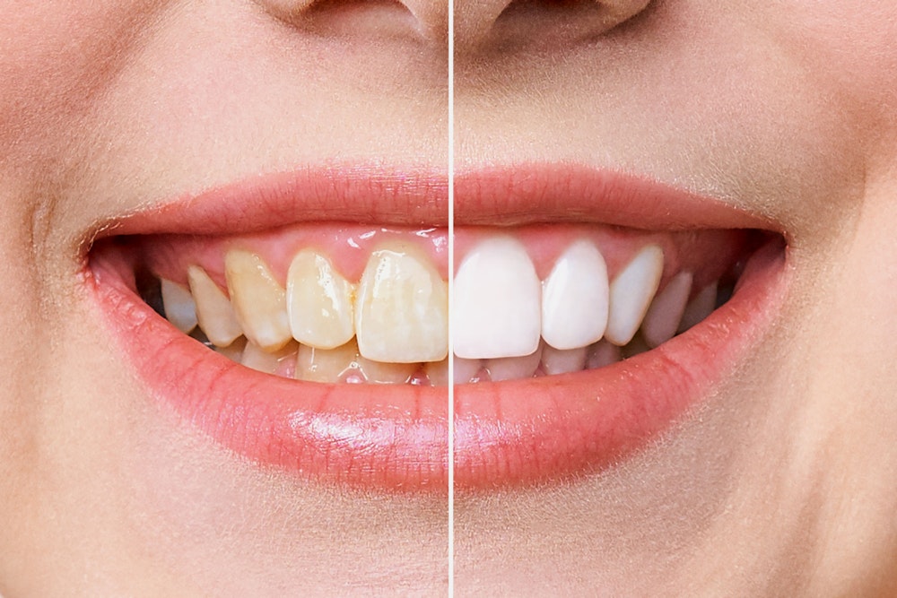 before and after whitening