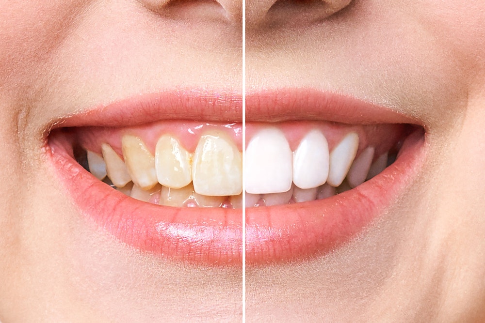 teeth whitening before and after