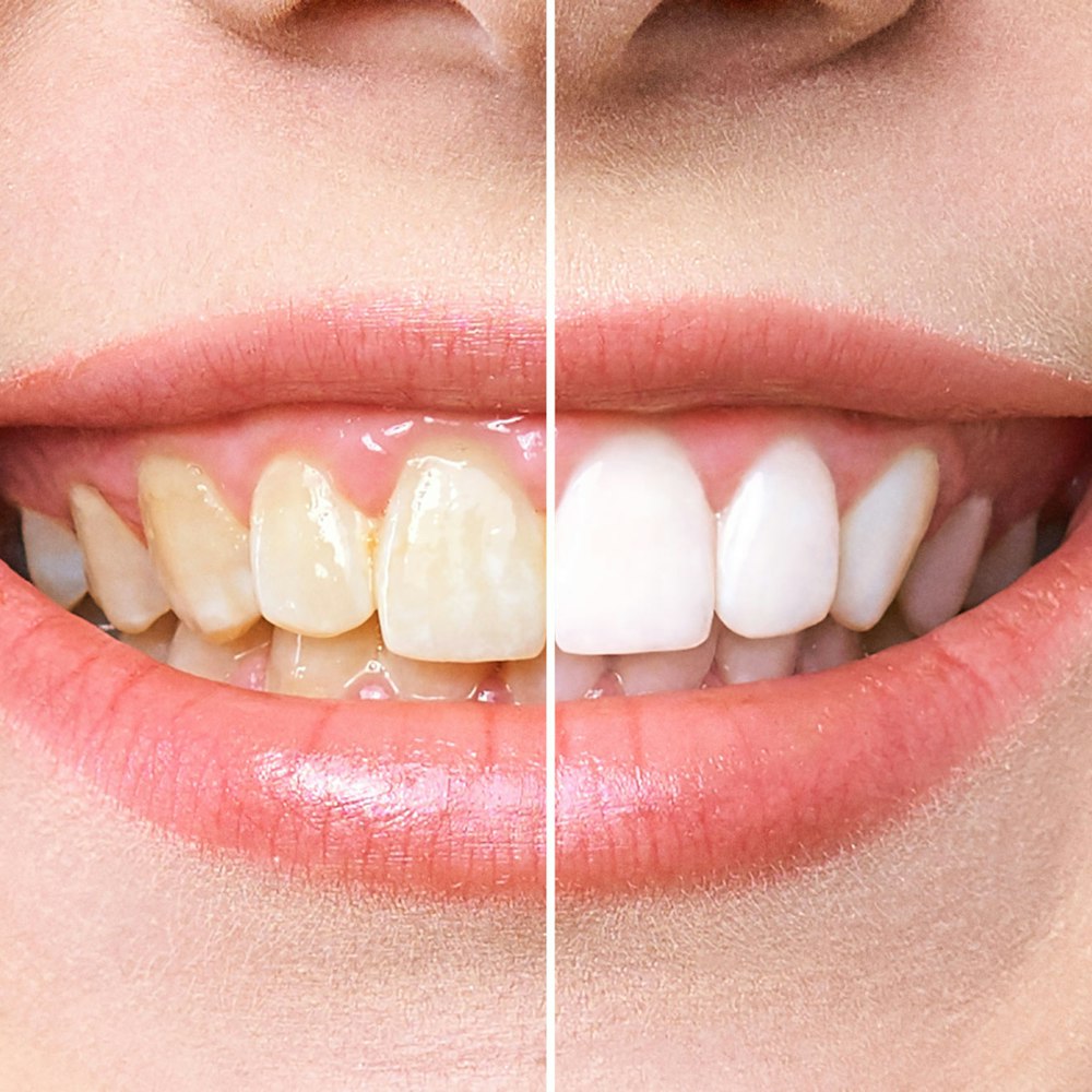 teeth whitening before and after