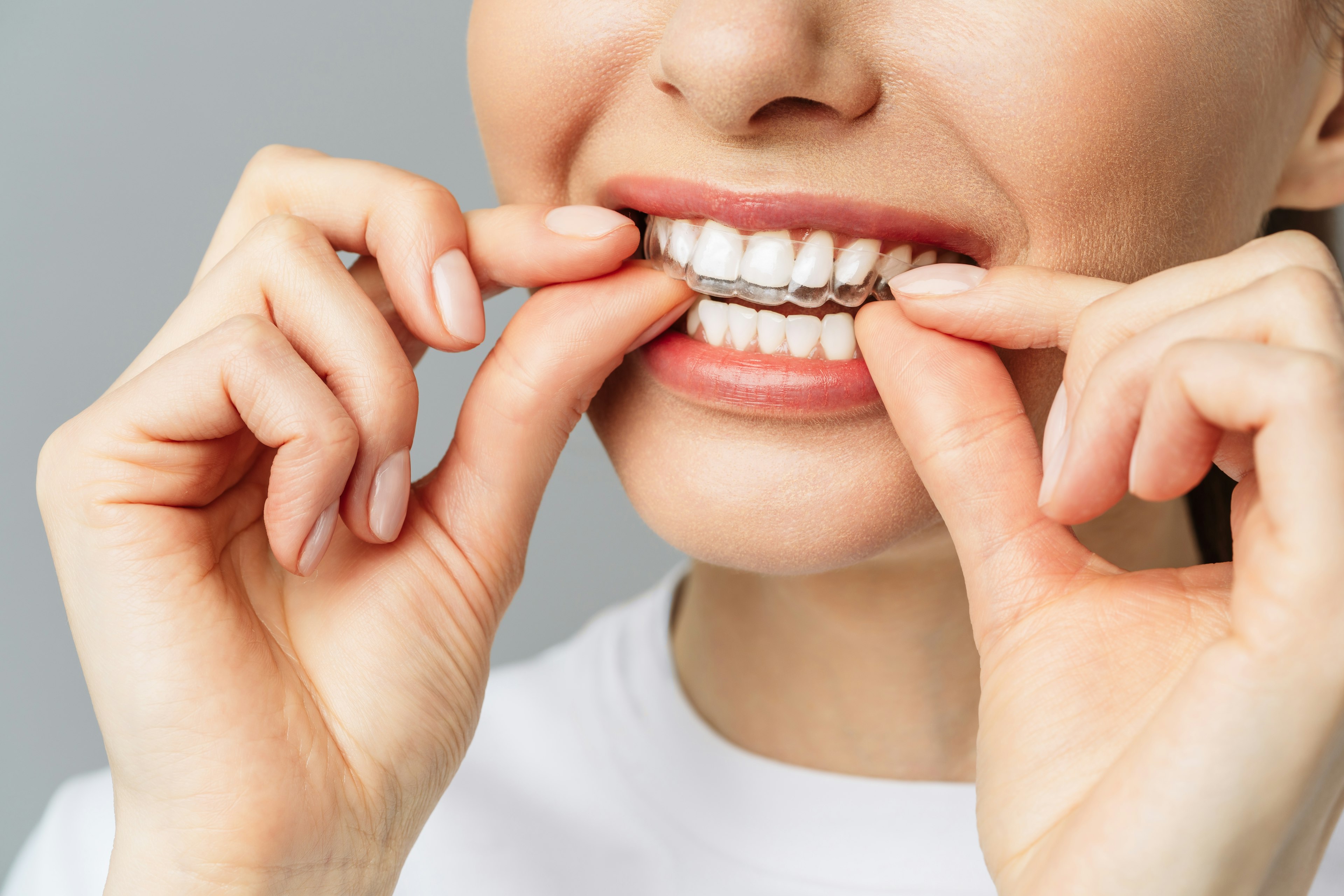Woman placing home kit whitening aligner on