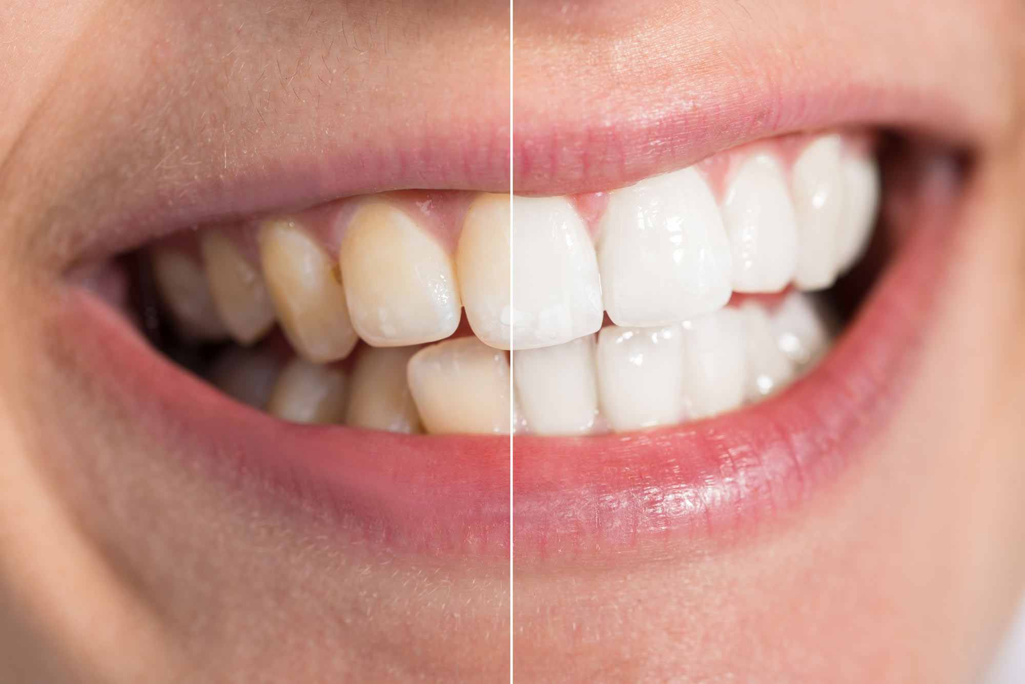 Teeth whitening patient