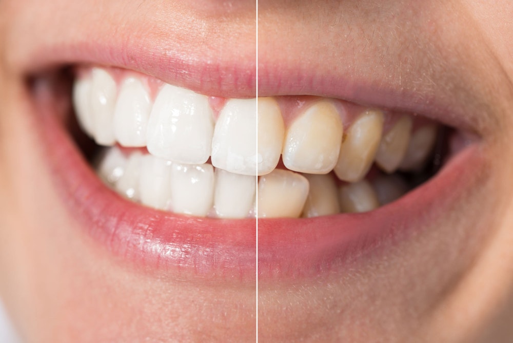 Teeth whitening patient