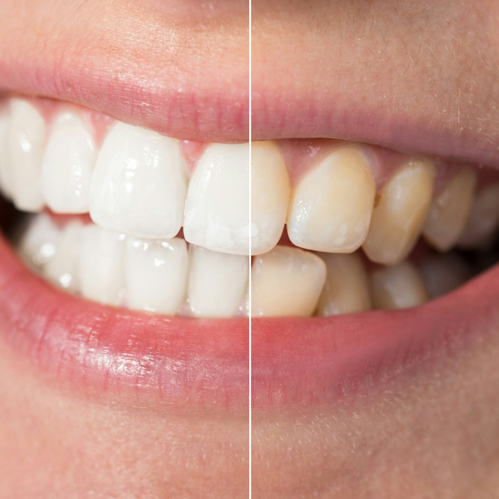 Teeth whitening patient