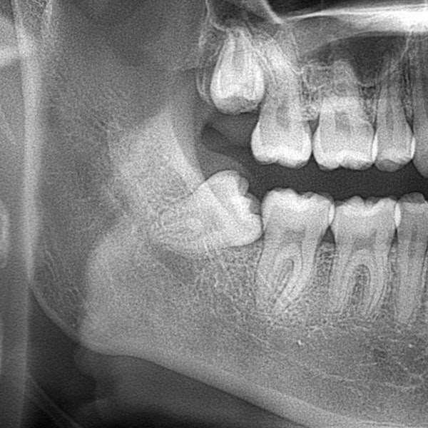 Wisdom tooth xray