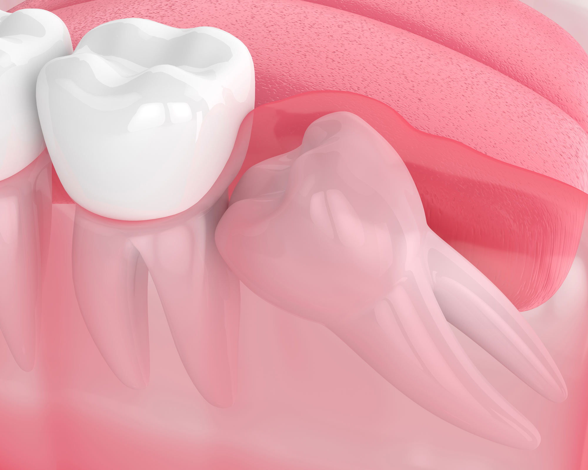 Impacted wisdom tooth