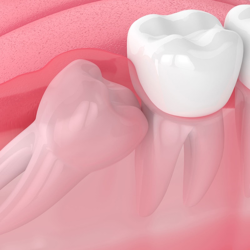 Impacted wisdom tooth